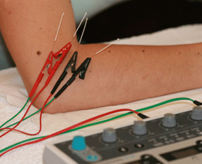bournemouth-electro-acupuncture